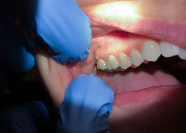 Best Emergency Tooth Extraction in Clarkston, GA